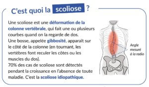 Illustration scientifique montrant un schéma d'angle de scoliose